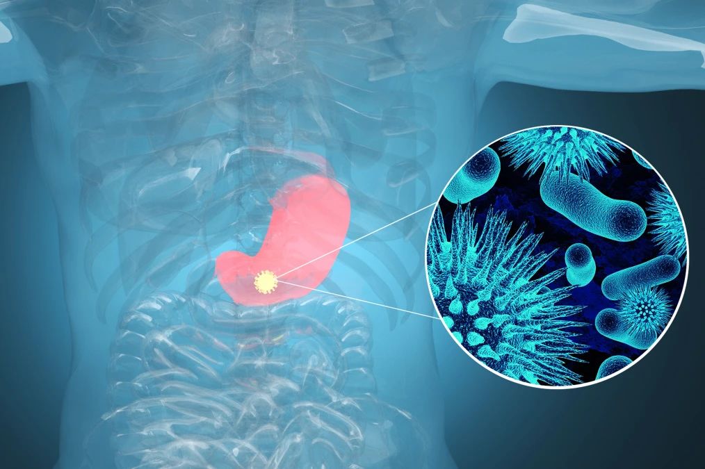 腫瘤標(biāo)記物CA72-4：“胃”，你還好嗎？